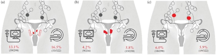 Magnetic resonance imaging and ultrasound examination in preoperative pelvic staging of early-stage cervical cancer: post-hoc analysis of SENTIX study.