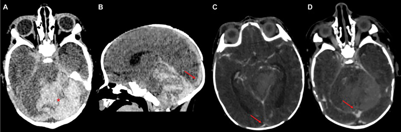 Early Enoxaparin Treatment in a Newborn with Cerebral Venous Sinus Thrombosis and Acute Cerebellar Hemorrhage.