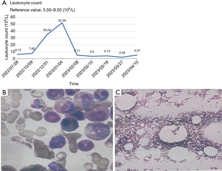 Chronic myeloid leukemia in a patient treated with palbociclib and exemestane: a case report.