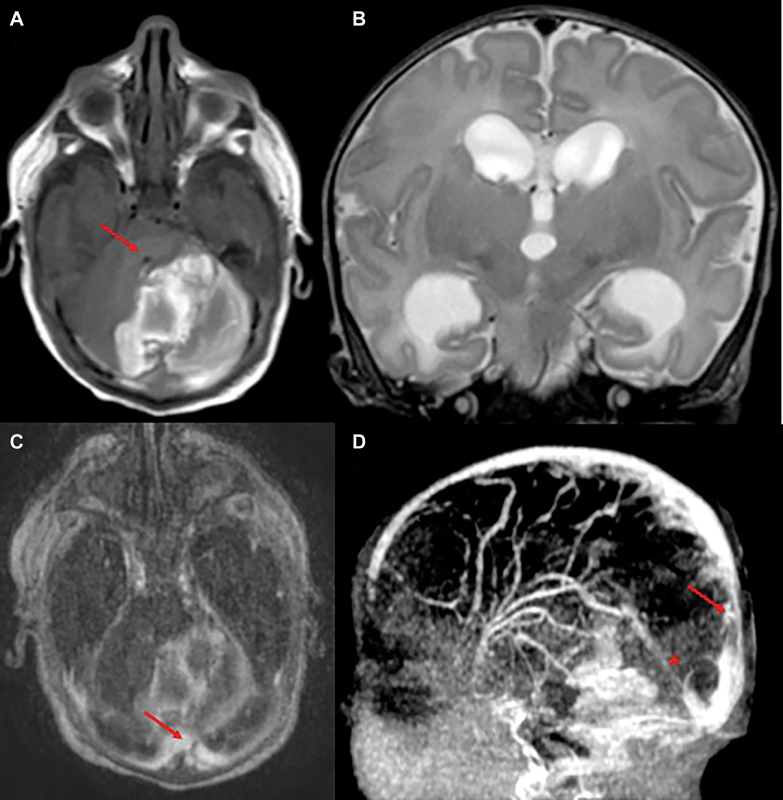 Early Enoxaparin Treatment in a Newborn with Cerebral Venous Sinus Thrombosis and Acute Cerebellar Hemorrhage.