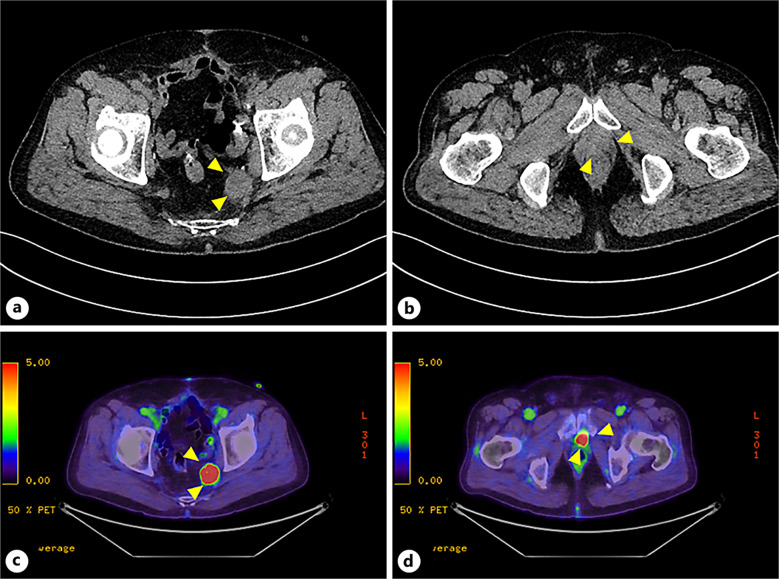 Enfortumab Vedotin-Induced Diabetic Ketoacidosis and Acute Tubulointerstitial Nephritis Requiring Intensive Care in the Treatment of Advanced Urothelial Carcinoma: A Case Report.