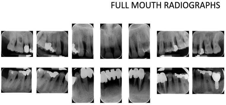 Periodontal Disease and Age-Related Maculopathy: A Case Report.
