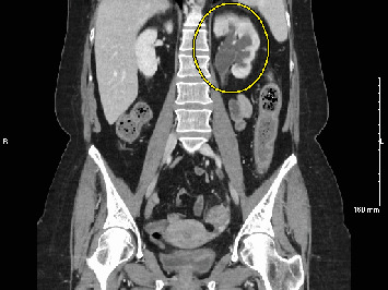 Recurrent Urosepsis Following Stent Removal for Ureteral Stones: A Case Report.