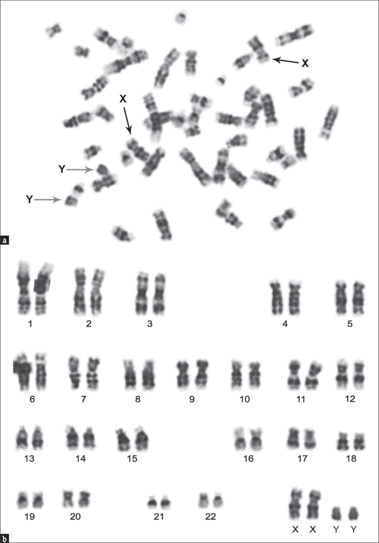 Rare 48, XXYY Syndrome with Primary Infertility and Behavioural Disorder: A Case Report.