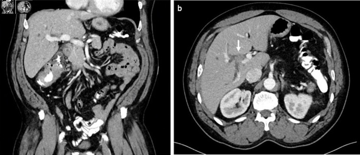 Solitary Synchronous Biliary Metastasis in Colorectal Adenocarcinoma.