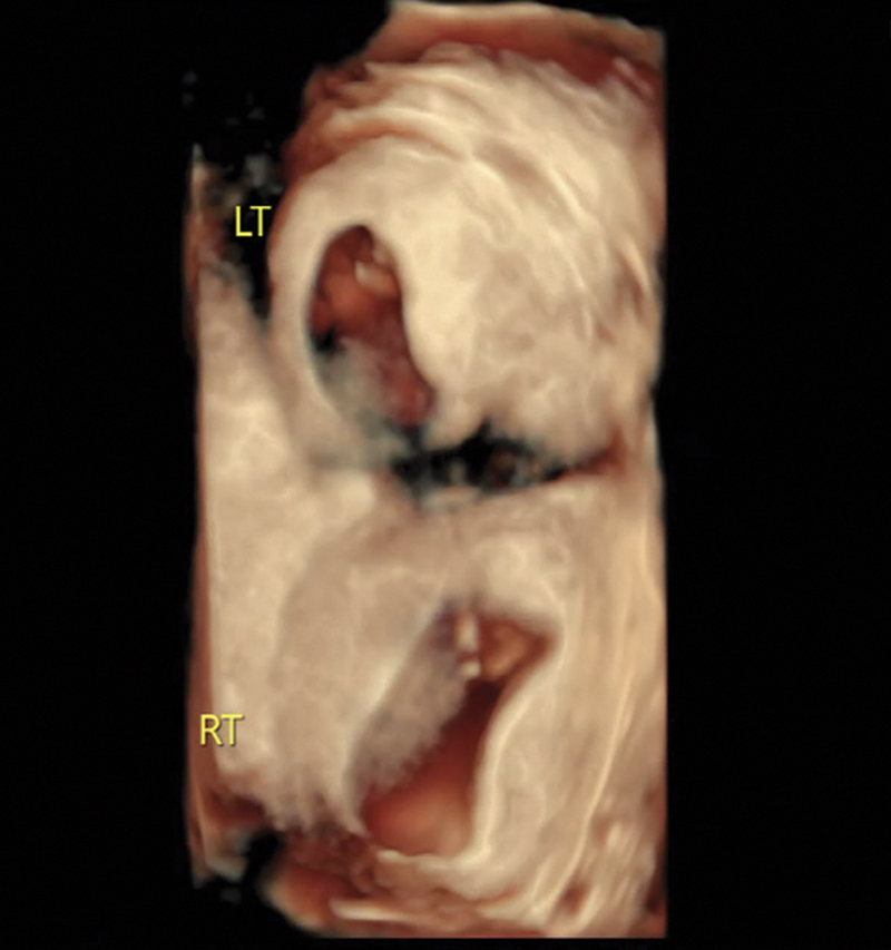 Di-Cavitary Twin Pregnancy in Didelphys Uterus with Associated Renal Agenesis.