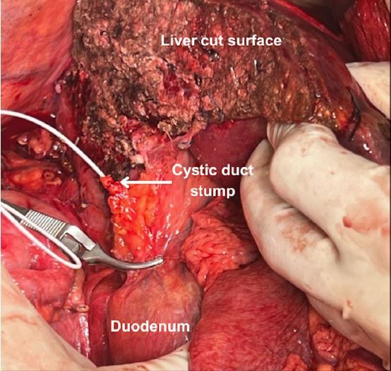 STANDARDIZATION OF THE WHITE TEST IN OPEN LIVER RESECTION: TOWARD NEAR-ZERO CLINICALLY SIGNIFICANT BILE LEAKAGE.