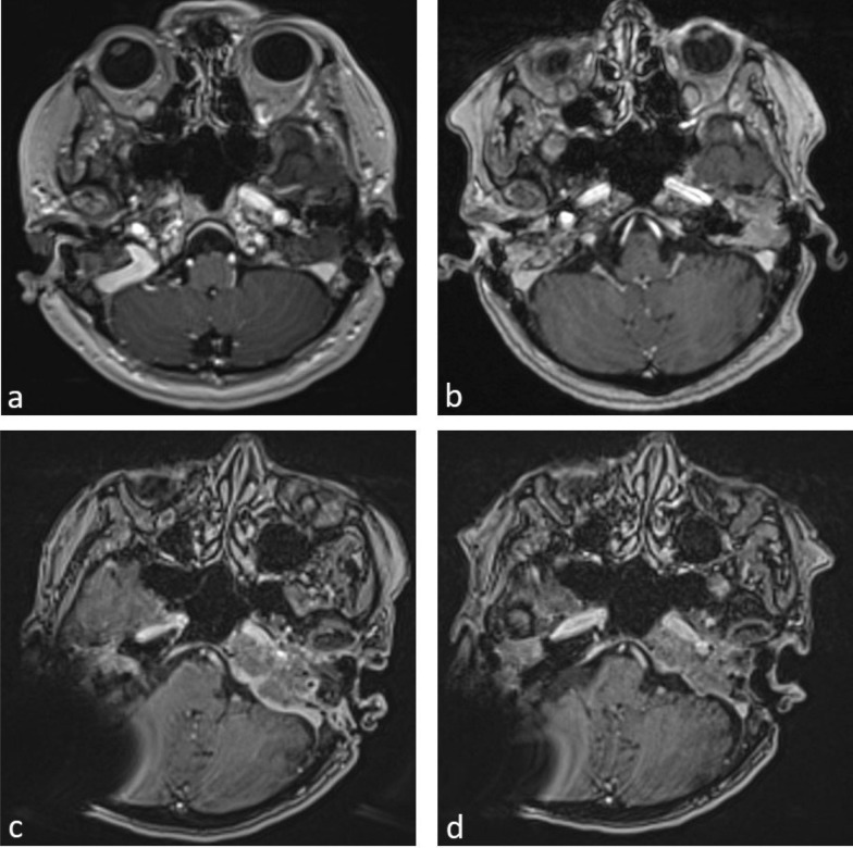 A pathogen-detection's odyssey in a case of skull base osteomyelitis: Land ahoy!