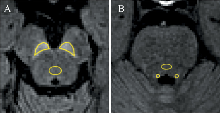 Comparison of 3D Magnetization-transfer- and Spectral-presaturation-with-inversion-recovery-based Neuromelanin Imaging.