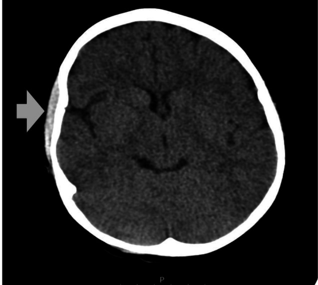 Spontaneous subgaleal haematoma with severe headache in two children during acute painful sickle cell crisis.