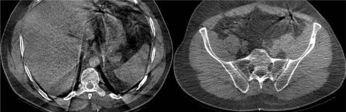 A rare cause of knee pain: Multiple intraosseous lipomas mimicking bone metastasis.