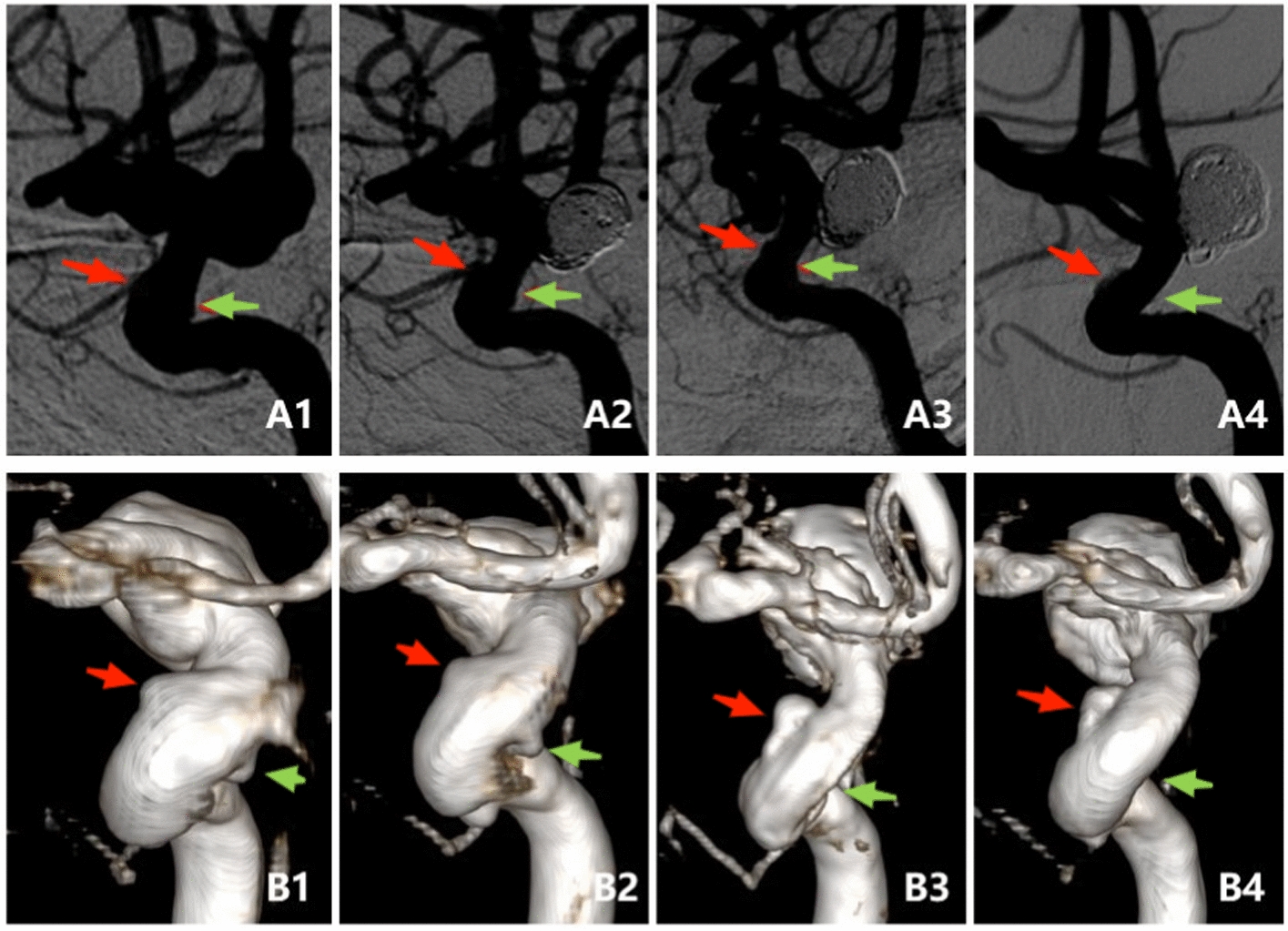 Exploration of the effect of morphology and location on hemodynamics of small aneurysms: a variable-controlled study based on two cases with tandem aneurysms.