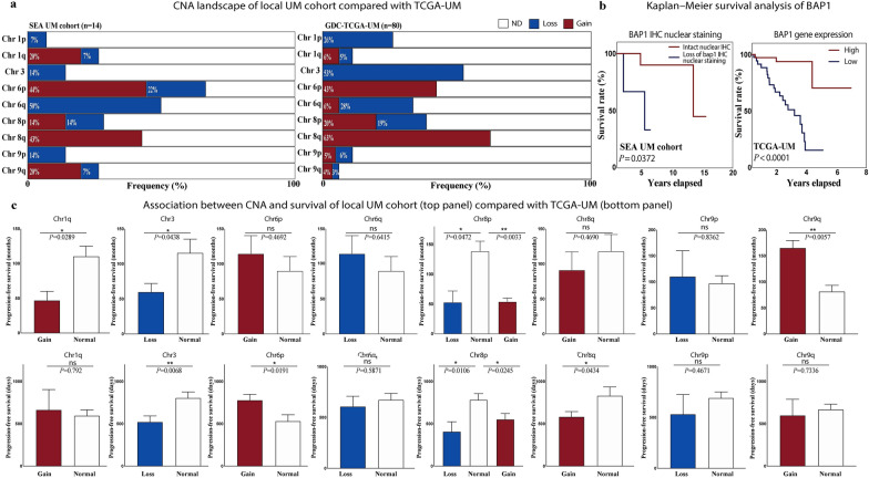 Genetic landscape of uveal melanoma in Southeast Asia: high 1q gains and unique patterns of metastasis risk.