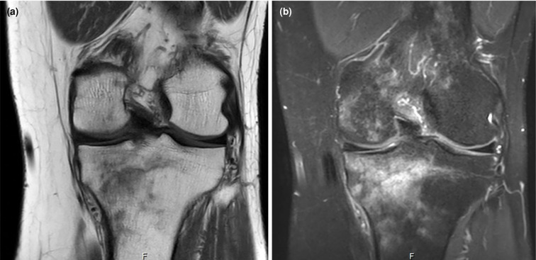 A rare cause of knee pain: Multiple intraosseous lipomas mimicking bone metastasis.