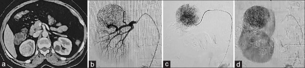 A novel method of using indocyanine green fluorescence technique for nephron-sparing surgery.