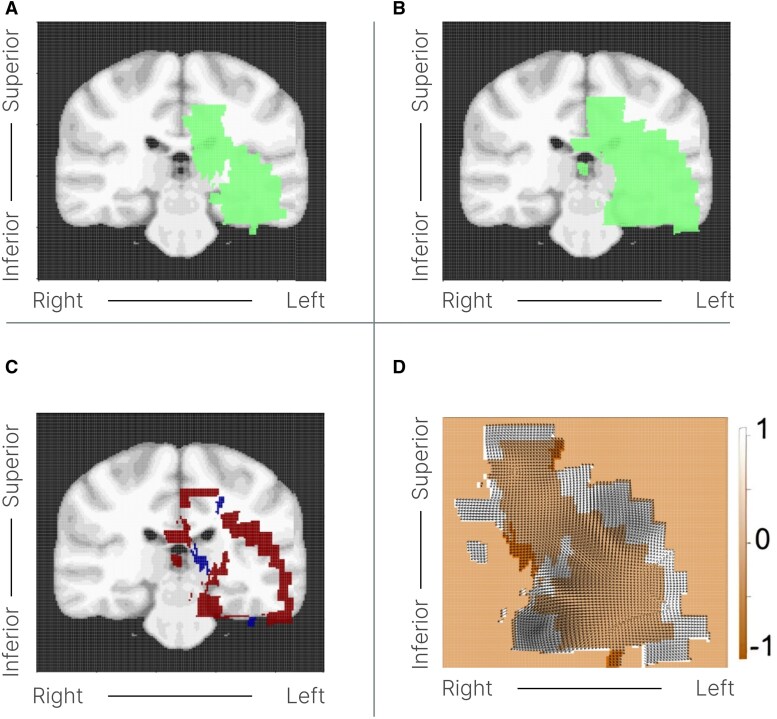 Low-grade gliomas do not grow along white matter tracts: evidence from quantitative imaging.
