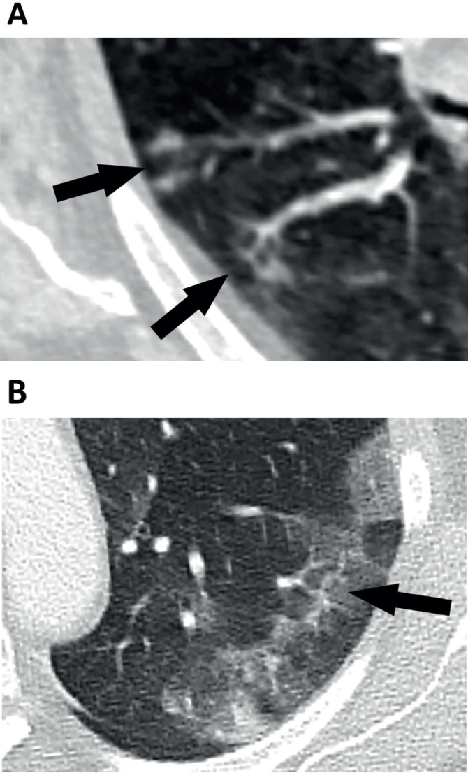 Chest computed tomography and plain radiographs demonstrate vascular distribution and characteristics in COVID-19 lung disease - a pulmonary vasculopathy.