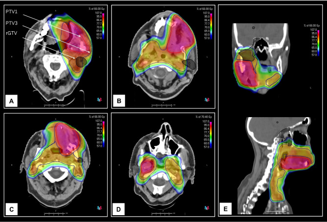 Combined Spatial and Dosimetric Recurrence Pattern Analysis in Head and Neck Squamous Cell Carcinoma Following Postoperative (Chemo)radiotherapy.