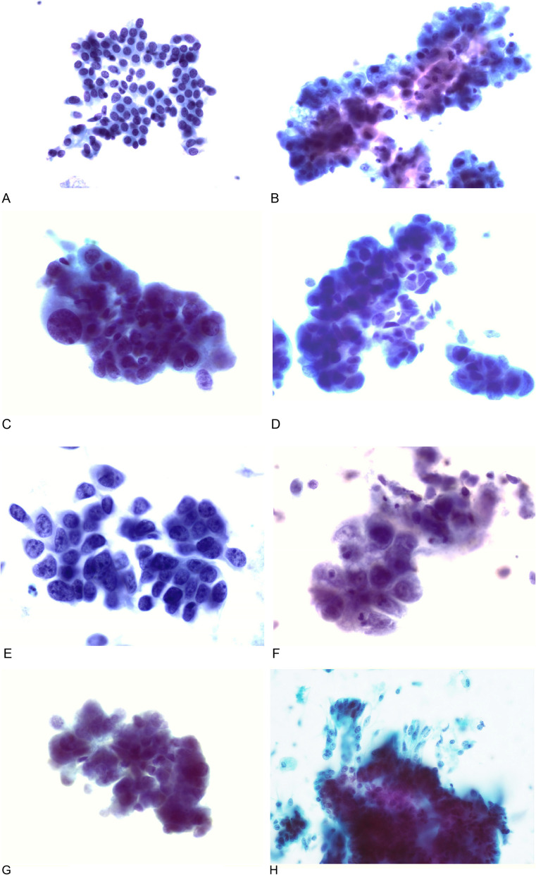 The morphological characteristics and arrangements of cells in the liquid-based cytology preparation of patients with endometrial lesions.
