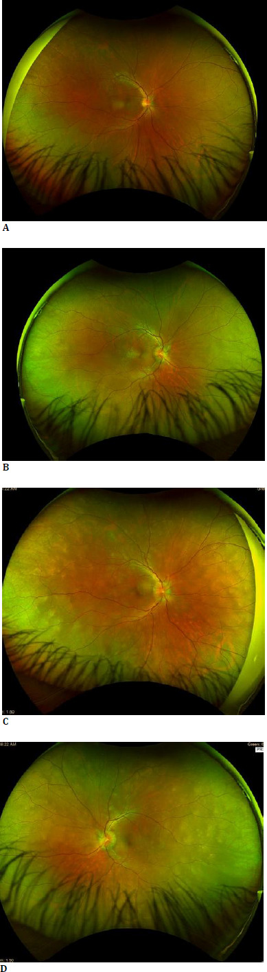 Beyond the Usual Suspects: Unilateral Optic Disc Edema as a Rare Initial Sign of Vogt-Koyanagi-Harada Syndrome.