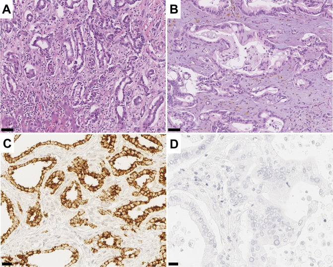 Combined analysis of albumin in situ hybridisation and C reactive protein immunohistochemistry for the diagnosis of intrahepatic cholangiocarcinoma: towards a molecular classification paradigm.