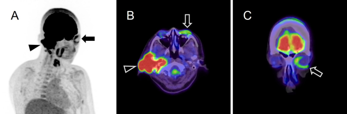 A Case of the Monocle Sign in Facial Nerve Palsy Caused by External Auditory Canal Cancer on 18F-fluorodeoxyglucose-positron Emission Tomography/Computed Tomography.