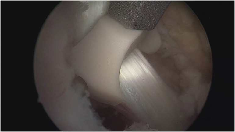 Does biceps tenodesis screw with forked eyelet decrease the risk of Popeye deformity when compared to traditional closed eyelet screws?