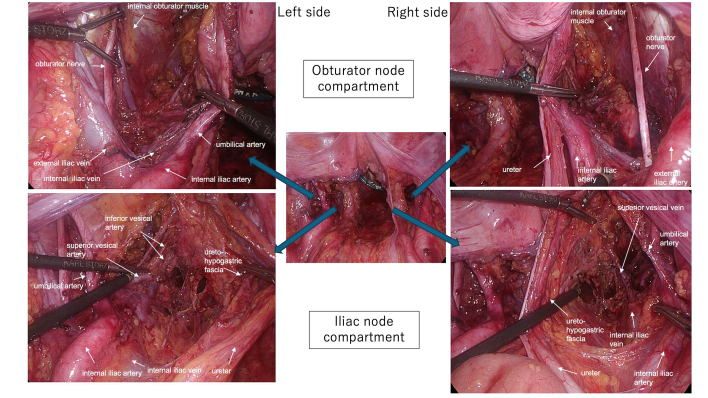 Short-term Outcomes of Robotic Lateral Pelvic Lymph Node Dissection for Lower Rectal Cancer.