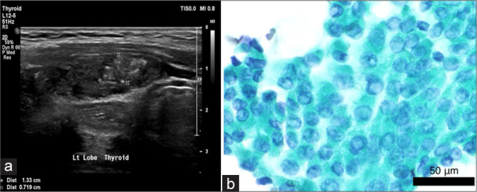 Comparative accuracy of fine-needle aspiration cytology between larger and smaller size thyroid nodules.
