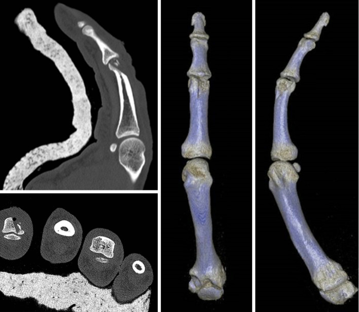 Osteochondral autograft from the second toe for complex proximal interphalangeal joint fracture-dislocations: a case report and literature review.