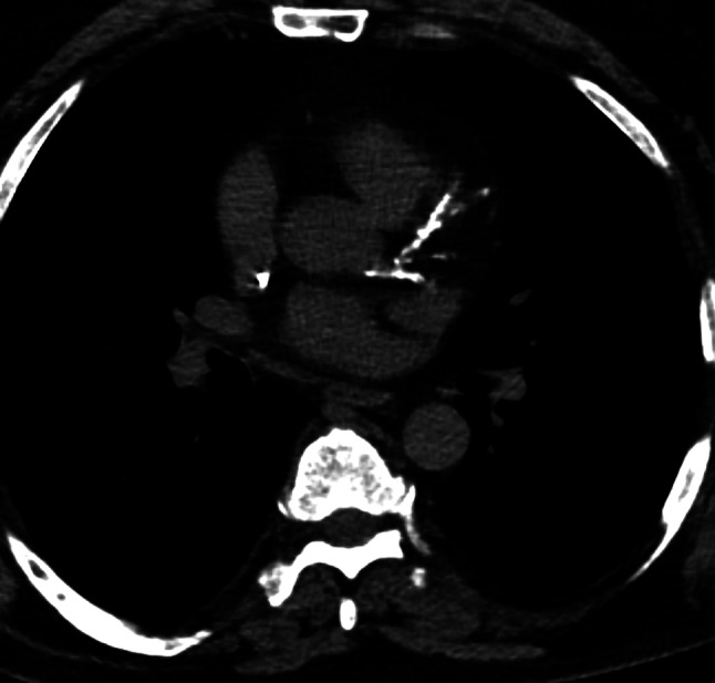 Coronary artery calcification score as a prognostic factor in younger patients with multiple myeloma undergoing autologous stem cell therapy.