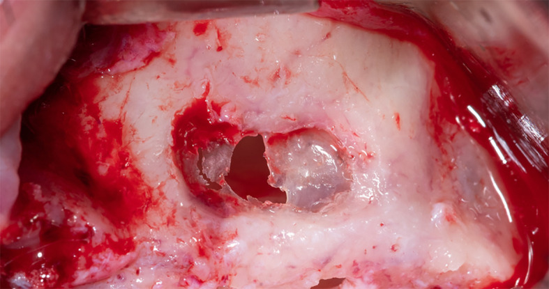 Case Report: A new modification of Loma Linda pouch technique.