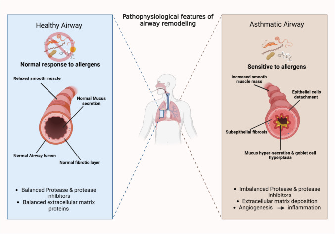 Targeting IL-13 and IL-4 in Asthma: Therapeutic Implications on Airway Remodeling in Severe Asthma.