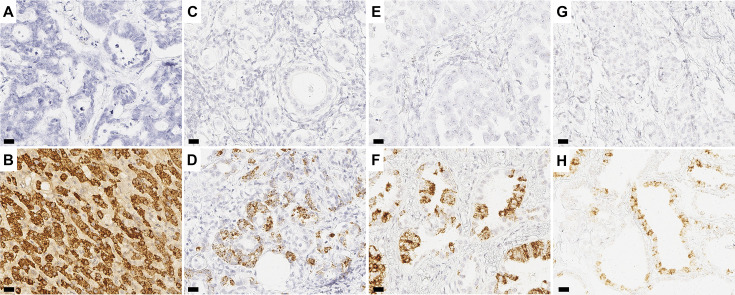 Combined analysis of albumin in situ hybridisation and C reactive protein immunohistochemistry for the diagnosis of intrahepatic cholangiocarcinoma: towards a molecular classification paradigm.