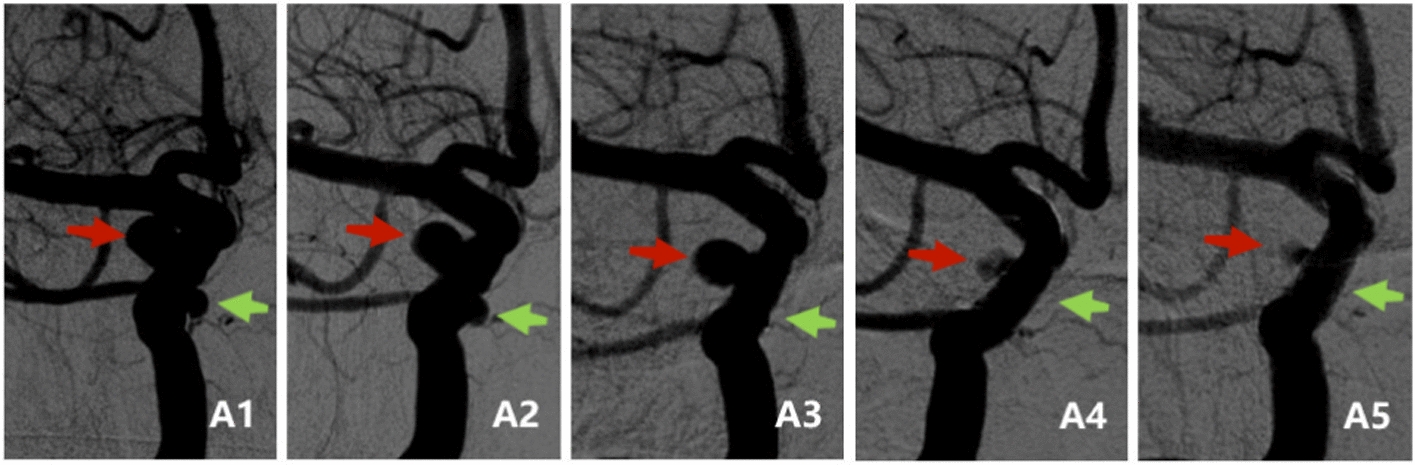 Exploration of the effect of morphology and location on hemodynamics of small aneurysms: a variable-controlled study based on two cases with tandem aneurysms.