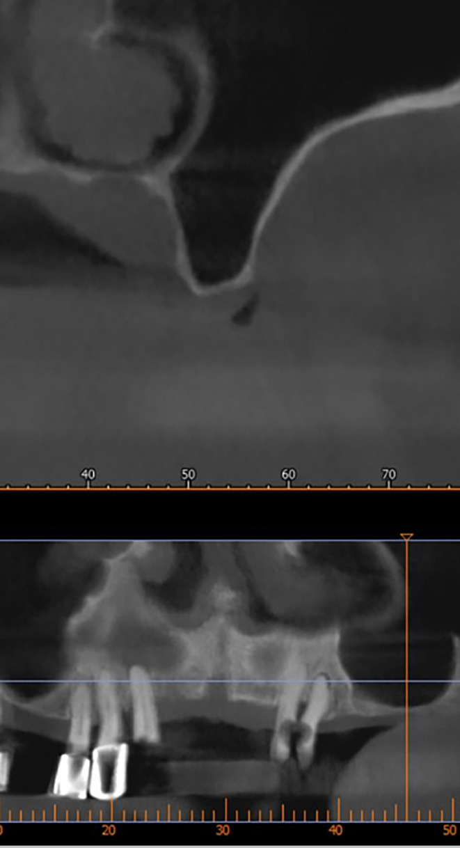Case Report: A new modification of Loma Linda pouch technique.