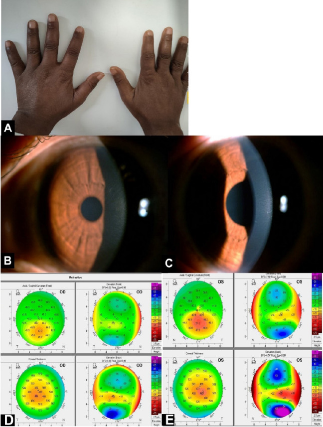 Bilateral Keratoconus in Diffuse Cutaneous Systemic Sclerosis: A Rare Presentation - Is There Any Role of Autoimmunity?
