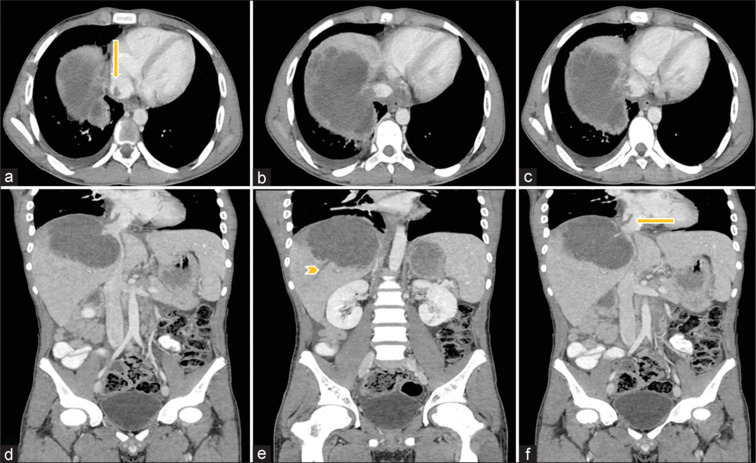 Vascular complications of amebic liver abscess - Computed tomography case series with review of the literature.