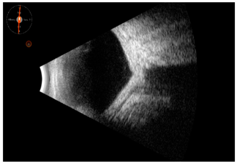 Ocular Ultrasound as a Key to Diagnosing Uveitis-Masked Syndromes: Tips and Tricks.