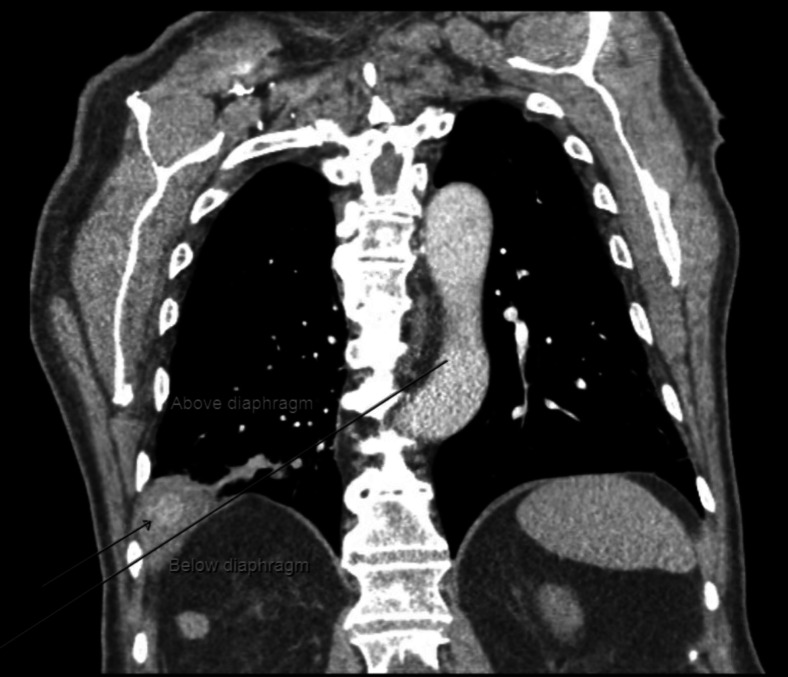 The Lost Gallstone: Thoracoscopic Removal of Retained Gallstone Following Cholecystectomy.