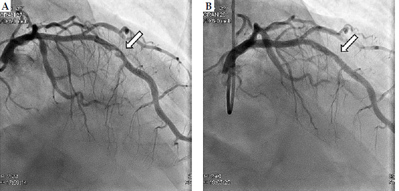A case of acute myocardial infarction due to Kounis syndrome after brachytherapy for prostate cancer.