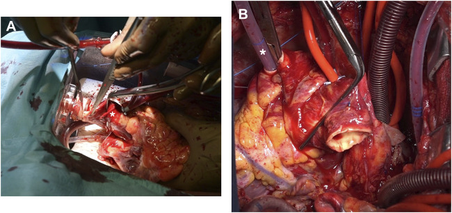 The Feasibility of a Beating-Heart Transplant From Brain-Dead Donors.