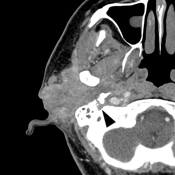 A Case of the Monocle Sign in Facial Nerve Palsy Caused by External Auditory Canal Cancer on 18F-fluorodeoxyglucose-positron Emission Tomography/Computed Tomography.