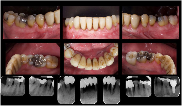 Periodontal Disease and Age-Related Maculopathy: A Case Report.