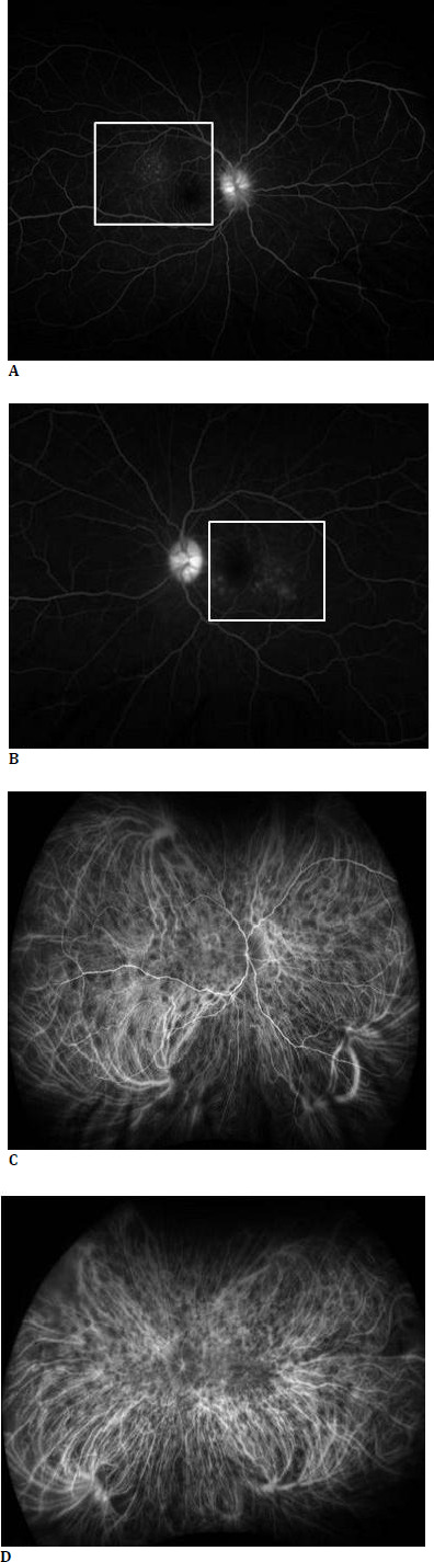 Beyond the Usual Suspects: Unilateral Optic Disc Edema as a Rare Initial Sign of Vogt-Koyanagi-Harada Syndrome.