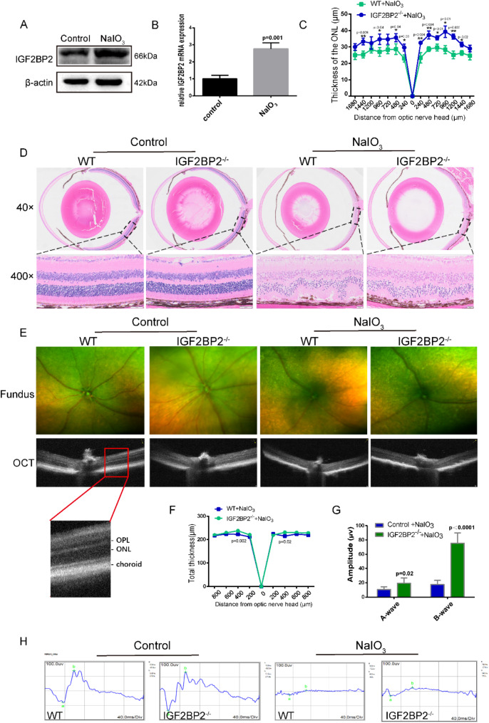The role of IGF2BP2 in macrophage-mediated NLRP3 inflammasome activation in the pathogenesis of dry AMD.