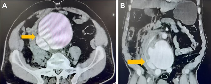Ruptured abdominal aortic aneurysm and aortocaval fistula: a highly lethal find.
