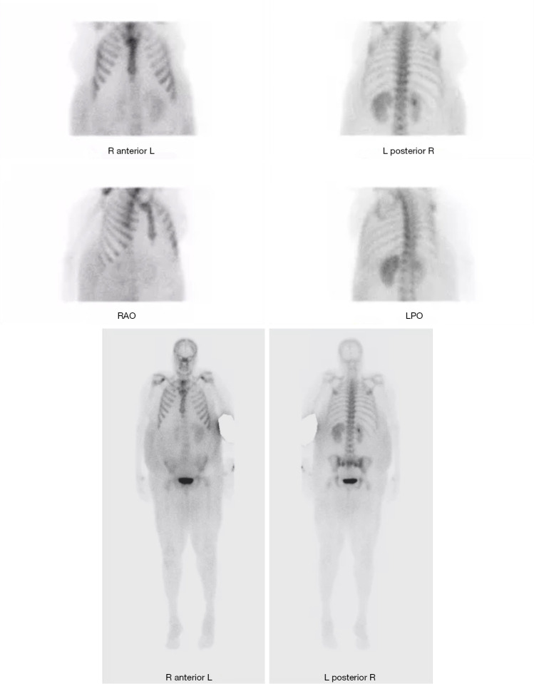 Humor me with calcium: a case report of humoral hypercalcemia of malignancy secondary to cholangiocarcinoma.