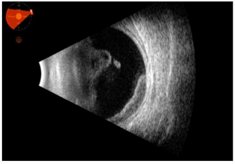 Ocular Ultrasound as a Key to Diagnosing Uveitis-Masked Syndromes: Tips and Tricks.