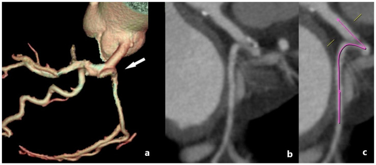 The Role of MDCT Coronary Angiography in the Detection of Benign Varieties and Anomalies of Coronary Blood Vessels-A Narrative Review.